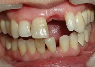 单颗牙齿缺失有什么危害?