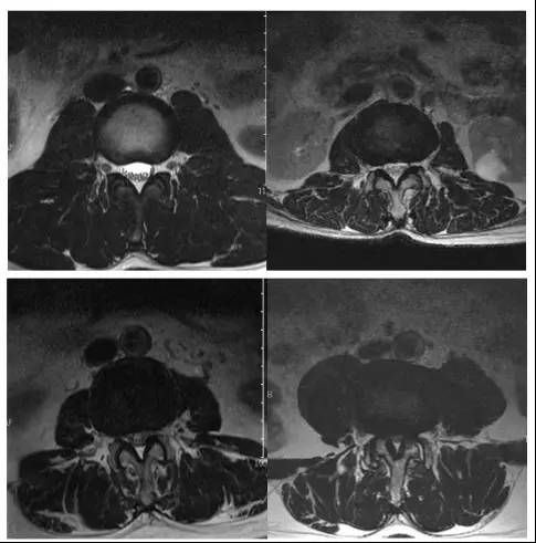 圖 4 前方腦脊液空間閉塞分級的腰椎 mri 橫斷面 t2wi 圖像示意.