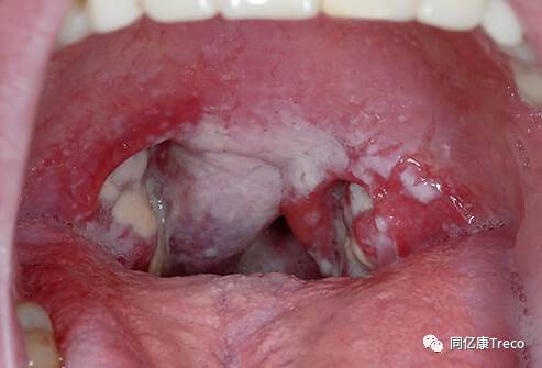 喉咙白斑是什么病图片