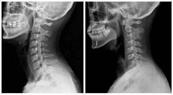 去医院拍片一看 医生说是颈椎出了问题(左侧是正常人的颈椎,右边是变