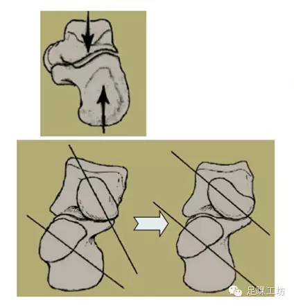 跟骨內翻 鎖定跗橫關節(距舟 跟骰)跟骨外翻 解鎖跗橫關節(跟舟 跟骰)