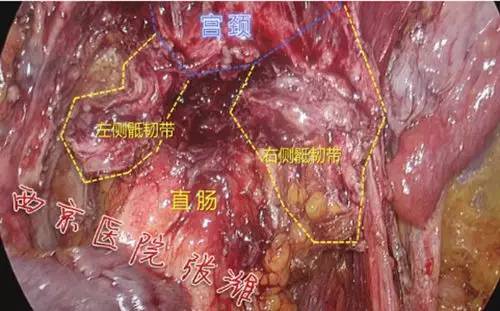 真骨盆入口上方乙狀結腸繫膜可見轉移灶子宮,膀胱,側盆壁腹膜表面均