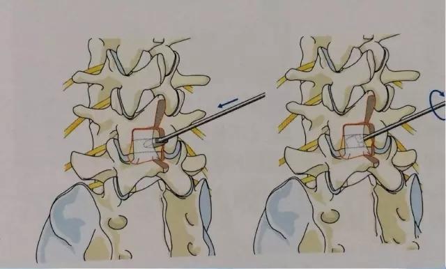 腰椎间盘突出患者手术,首先要知道手术是什么样的