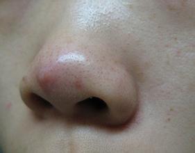 其实鼻子上长痘痘在鼻子不同的位置反映出来的也不一样.