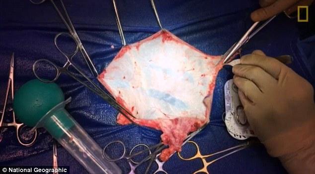 变性手术全过程卫生巾图片