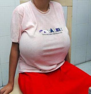 10岁女孩乳房发育图片