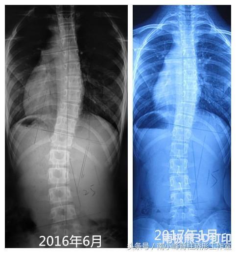 女孩穿3d打印支具半年脊柱侧弯从25度恢复到15度