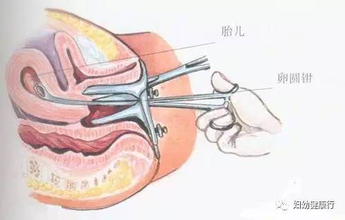 刮宫手术 真实图片