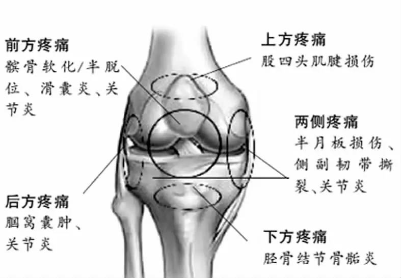 由跑步中引起的膝关节疼痛一般是膝关节周围肌肉过度牵拉造成