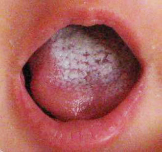 长成一层乳白色的膜,它可以出现在口腔里的任何地方,比如嘴唇,舌头