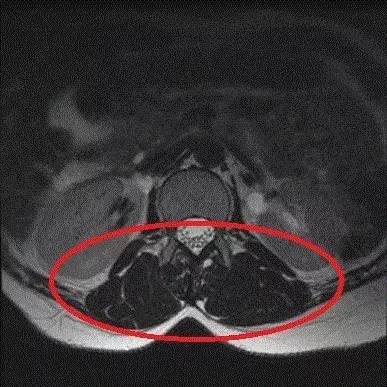 竖脊肌CT图片