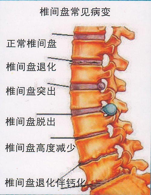 腰椎间膨出图与正常图图片