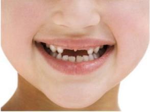 孩子牙齿健康知识小孩子龅牙怎么办
