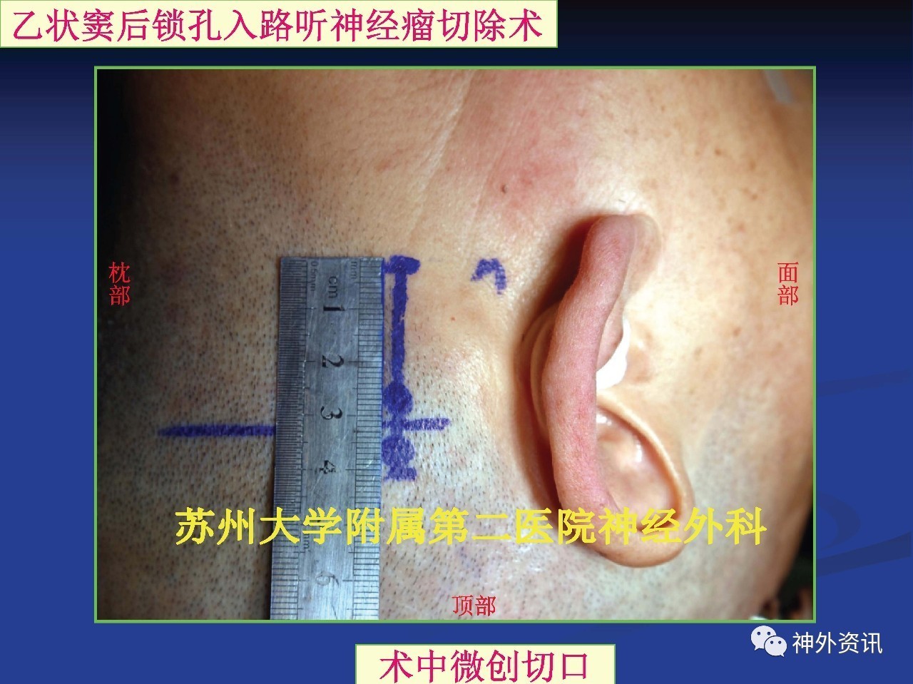 乙状窦后入路切口设计图片