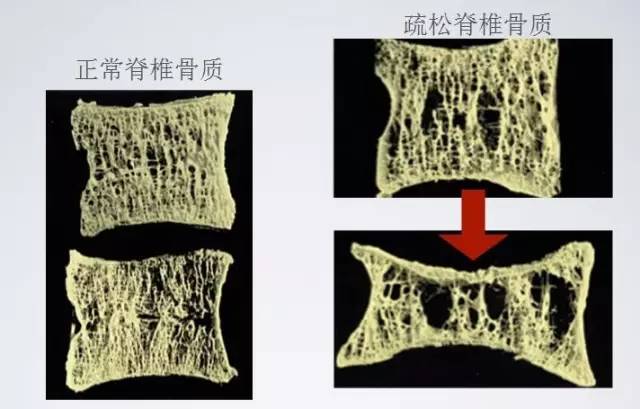 骨质疏松竟有这么多危害国家级老中医许鸿照教你如何预防