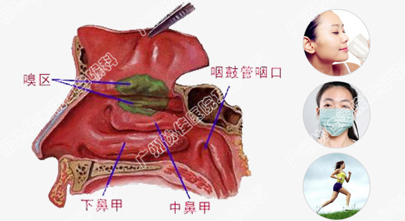 鼻粘膜水肿怎才能消除图片