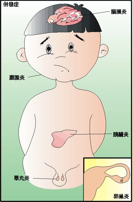 儿童腮腺炎位置图片图片