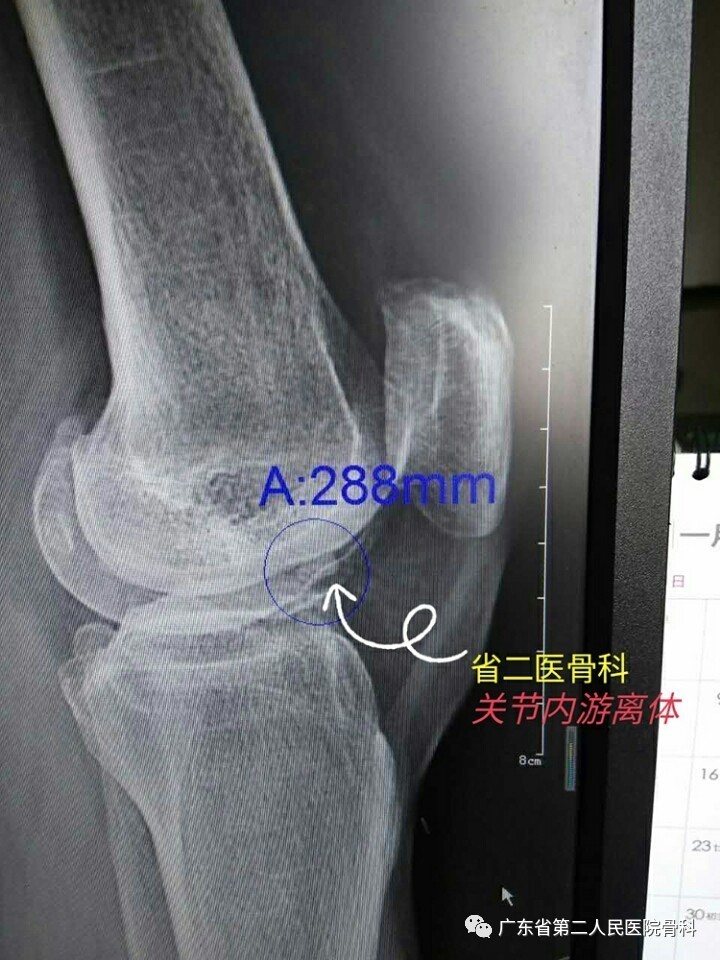 膝关节内游离体科普与案例分享