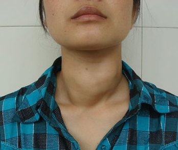 女性甲减早期脖子图片图片