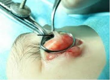 霰粒肿的手术步骤图片图片