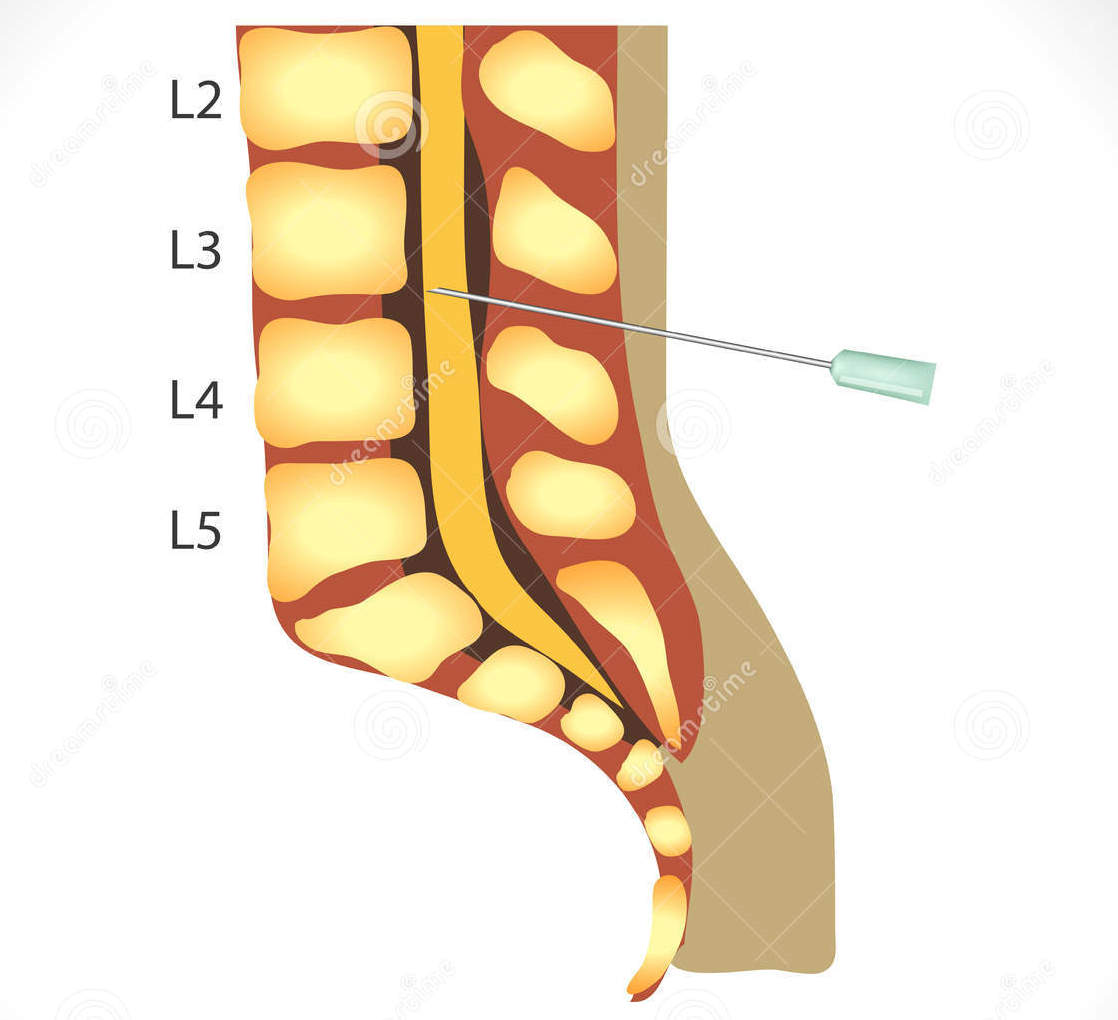 腰椎穿刺图片构造图解图片