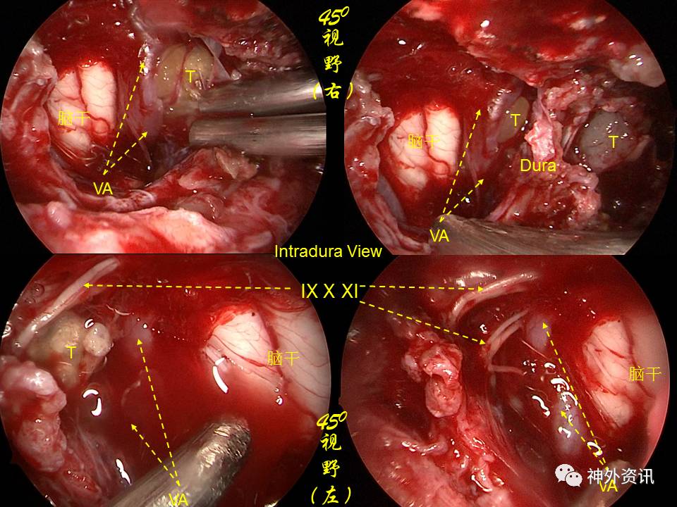 正海妙术视界王义宝教授下斜坡颅底内外沟通性脊索瘤的内镜经鼻一期