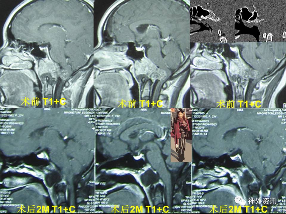 脊索瘤图片及讲解图片