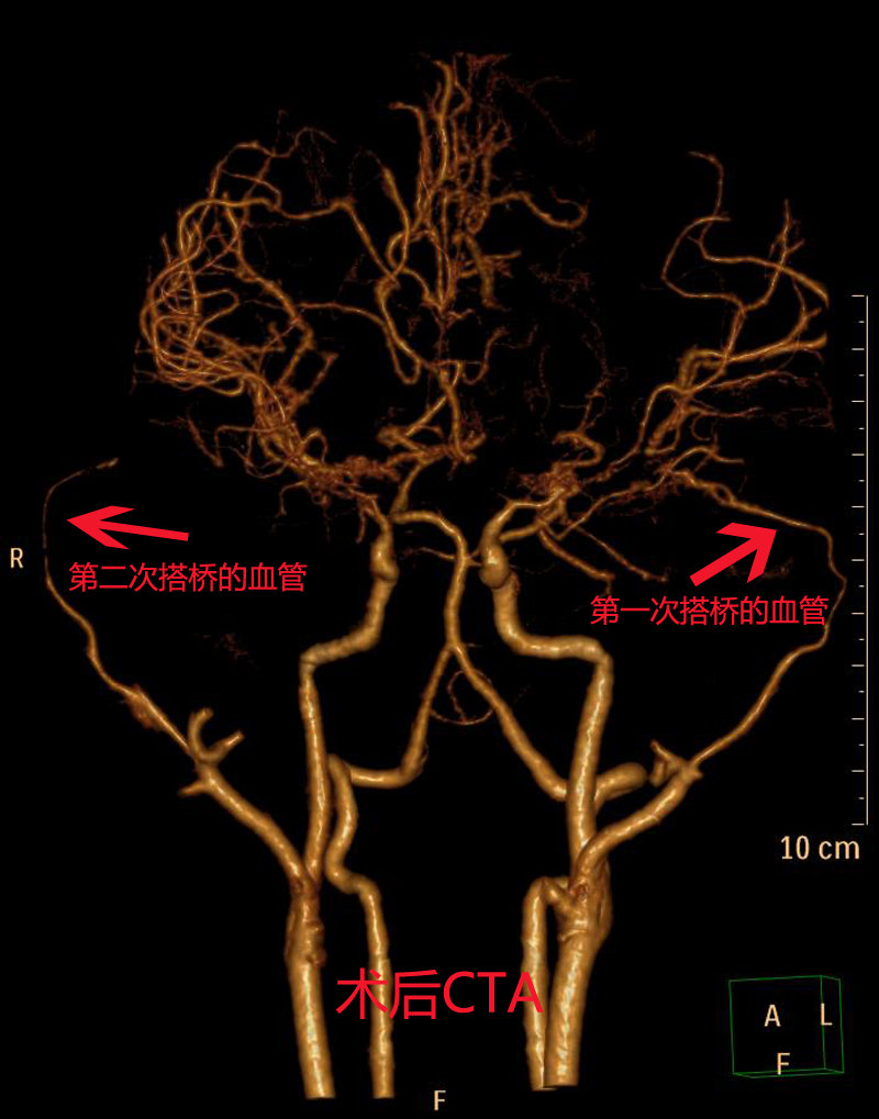 烟雾病手术病例:右侧颞浅动脉