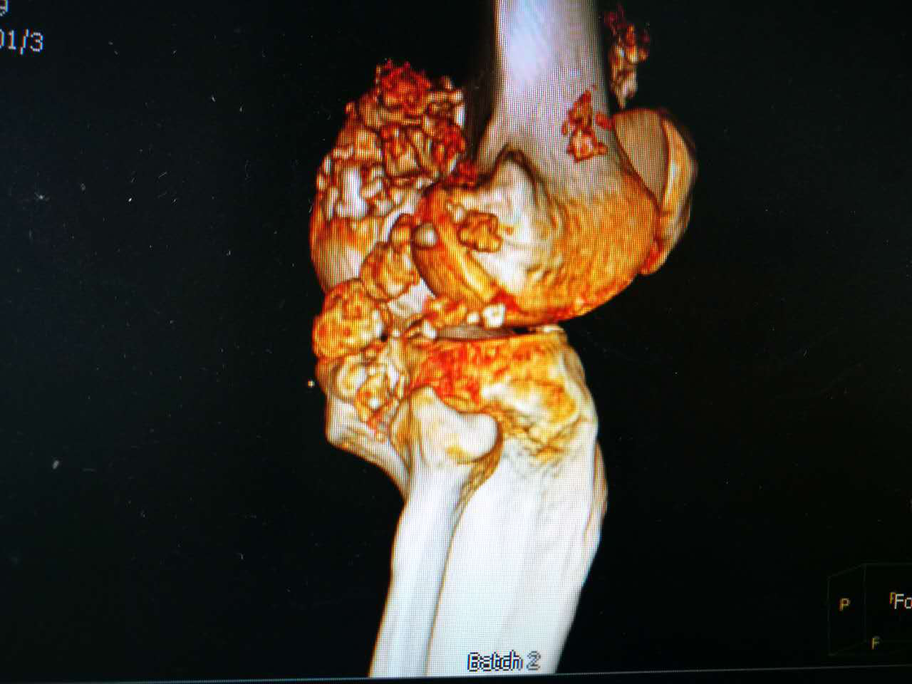 (入院后检查,右膝ct三维重建)右膝长出"珊瑚礁,原是罕见滑膜软骨瘤1