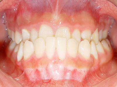 您的牙齿出现这一症状应及时矫正!