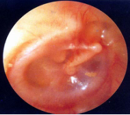 中耳炎耳膜充血图片图片