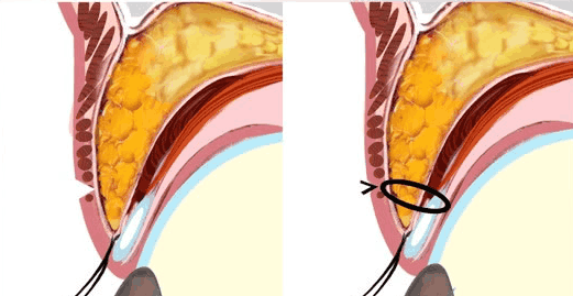 埋线双眼皮的原理图片图片