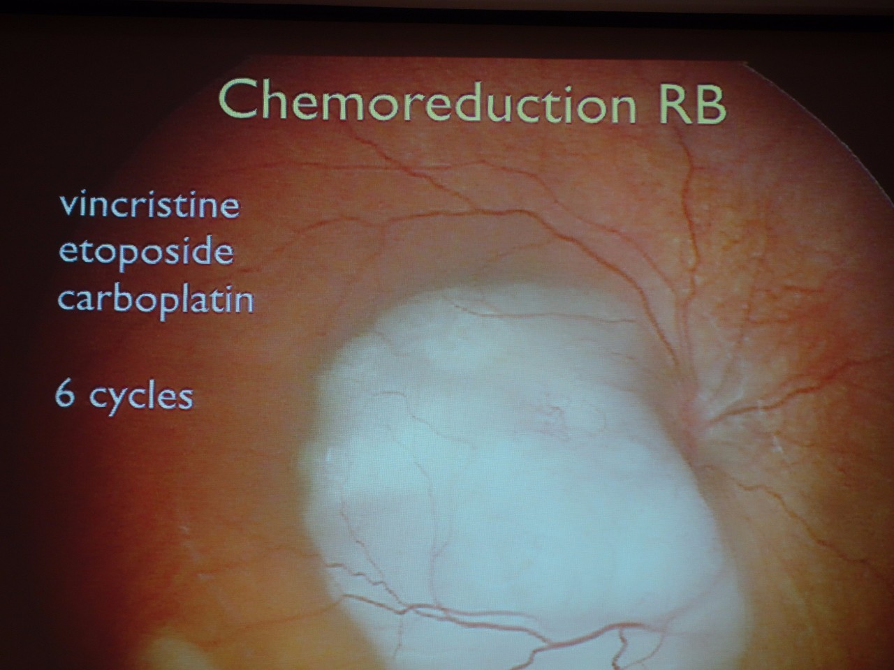 视网膜母细胞瘤影像图片