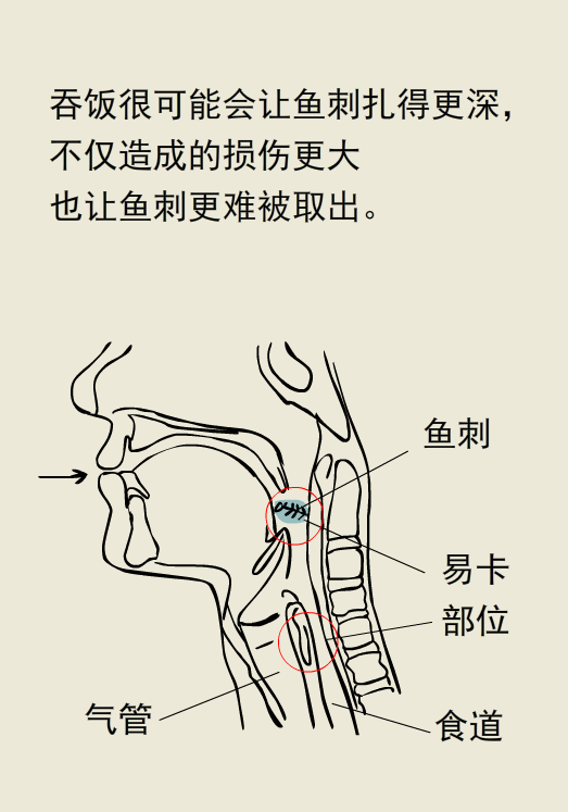 喉咙被鱼刺卡住了,喝醋真的管事吗?