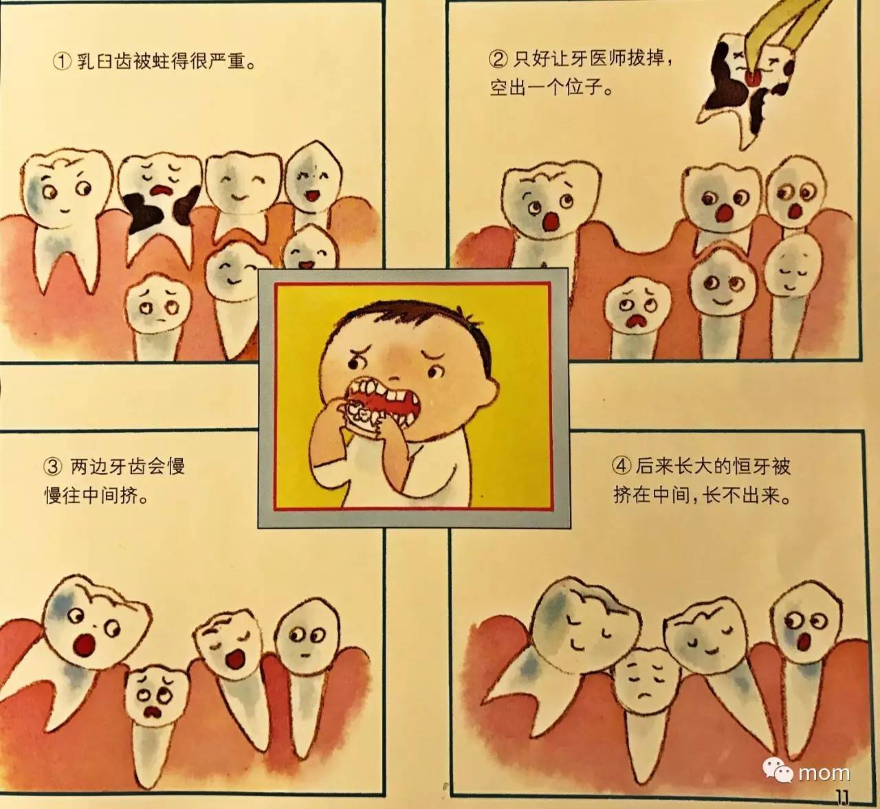 乳牙龋齿会危害孩子全身伴其一生不可不知