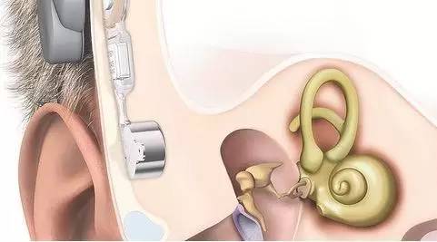 骨桥助听器植入图片