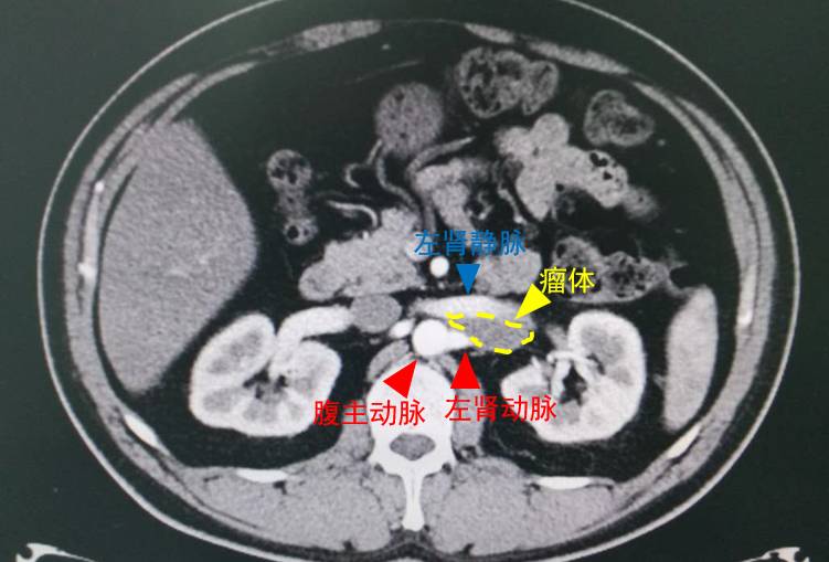 肾动脉CTA图片
