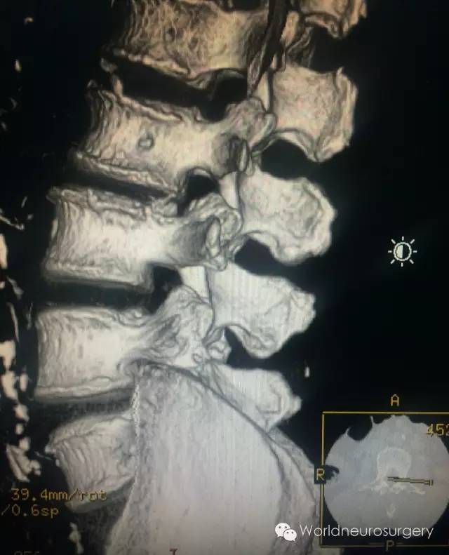 继续往下看,腰椎棘突需要你自己仔细看看侧位的腰椎x片,本人经过仔细
