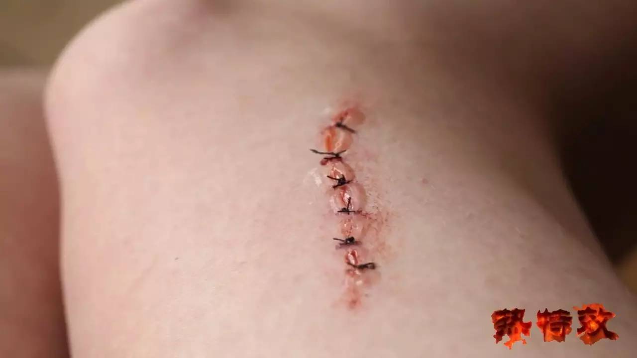 手术伤口缝合照片图片