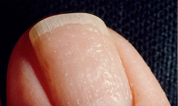 指甲甲基质图片