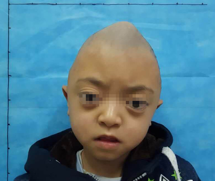 了湖南省儿童医院,孩子被确诊为罕见的遗传性家族性颅面骨发育不全,必