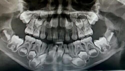 婴儿的牙齿x光片图片