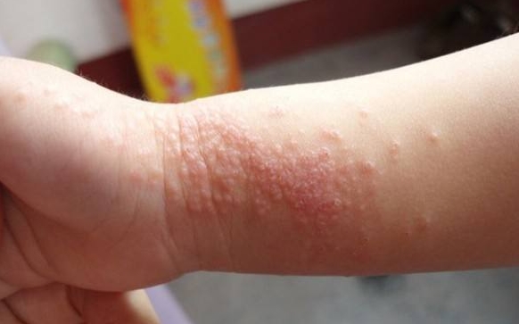 小孩手部湿疹怎么治疗图片