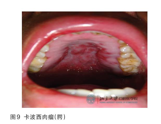 在口腔表现为弹性的红色或紫色肿块,有时可出现溃疡,好发于上腭和牙龈