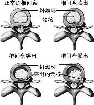 长期体力活导致腰椎间盘突出腿疼发麻可以治疗好吗