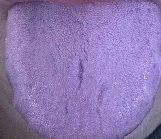 舌头上有紫色淤点图片图片