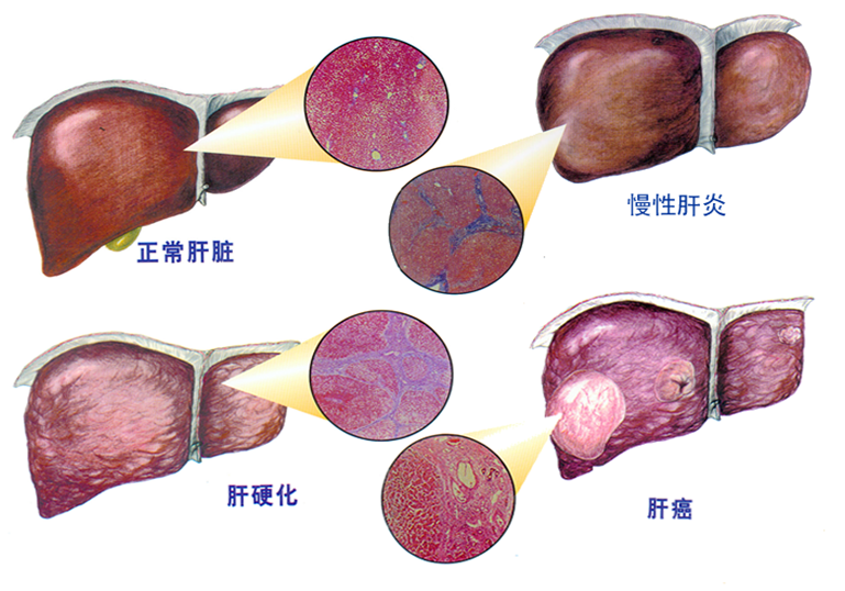 肌纖維化是可以好轉的