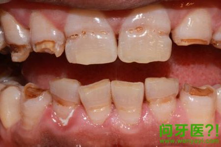 牙齿发黄是什么疾病?