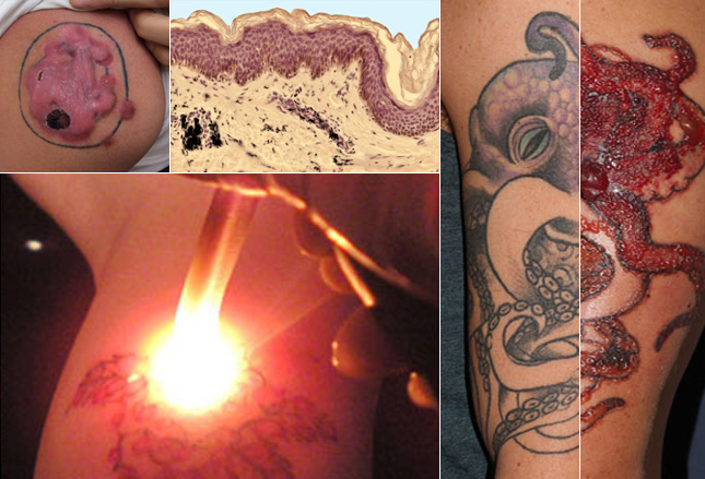 纹身引起的惨案纹身容易去除难不要轻易纹身