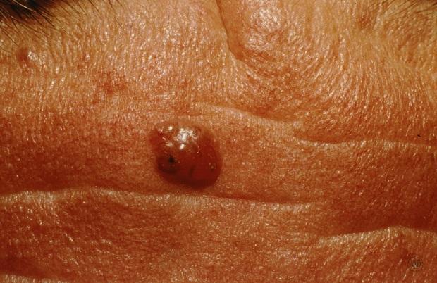 与良性肿瘤不同,这些恶性肿瘤常常是红色,鳞片状或珍珠状